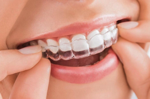 Top 5 Dia chi nieng rang Invisalign uy tin chat luong nhat tai TP. Thu Duc