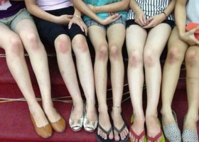 Top 8 Kem tri tham dau goi khuyu tay tot nhat hien nay