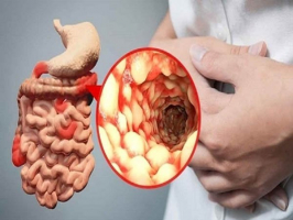 Top 10 Luu y quan trong nhat ve benh Crohn