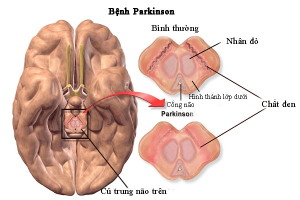 Top 4 Dia chi kham va dieu tri benh Parkinson tot nhat TP. Ho Chi Minh