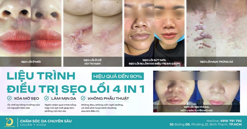 anh 1 tri seo loi 4 in 1