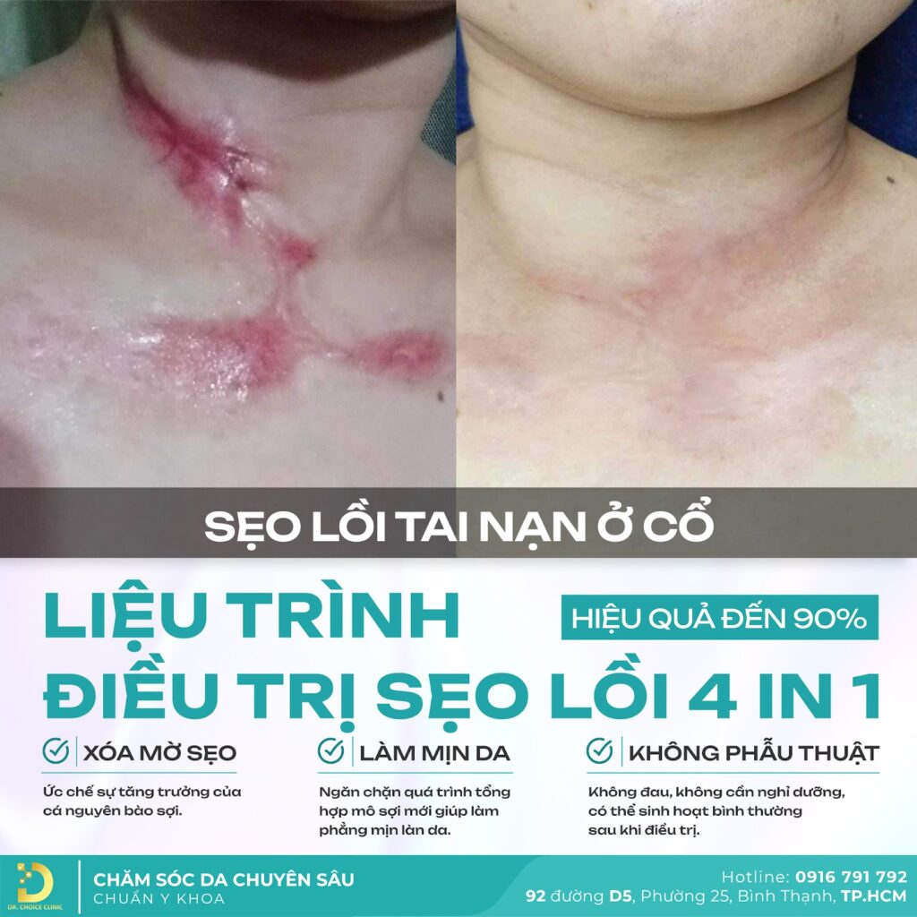 anh 2 tri seo loi 4 in 1 o co